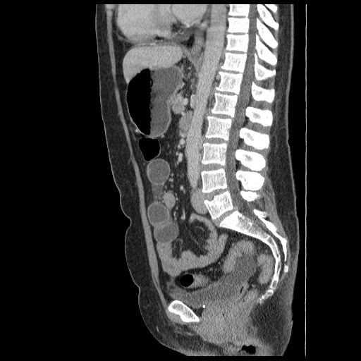 Closed loop small bowel obstruction (Radiopaedia 65403-74451 C 55).jpg