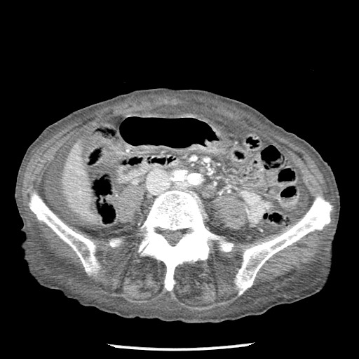 Closed loop small bowel obstruction - adhesions and infarct (Radiopaedia 85125-100678 B 57).jpg