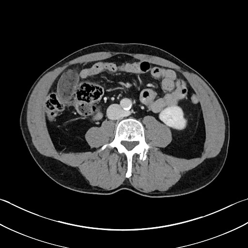 File:Closed loop small bowel obstruction - internal hernia (Radiopaedia 57806-64778 B 69).jpg