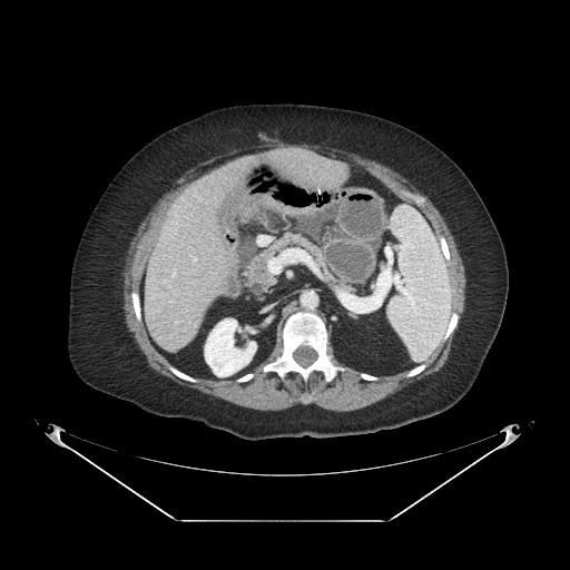 Closed loop small bowel obstruction - internal hernia (Radiopaedia 65402-74450 A 41).jpg