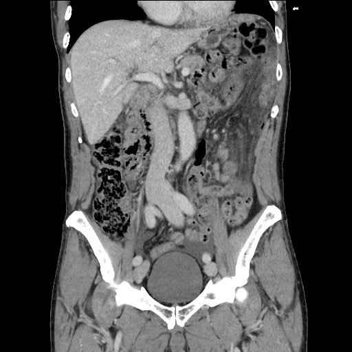File:Closed loop small bowel obstruction - omental adhesion causing "internal hernia" (Radiopaedia 85129-100682 B 60).jpg