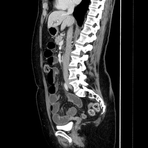 Closed loop small bowel obstruction due to adhesive bands - early and late images (Radiopaedia 83830-99015 C 85).jpg
