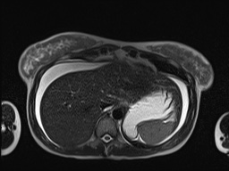 File:Closed loop small bowel obstruction in pregnancy (MRI) (Radiopaedia 87637-104031 Axial T2 12).jpg