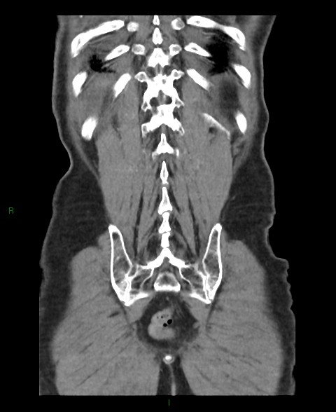 File:Closed loop small bowel obstruction with ischemia (Radiopaedia 84180-99456 B 7).jpg