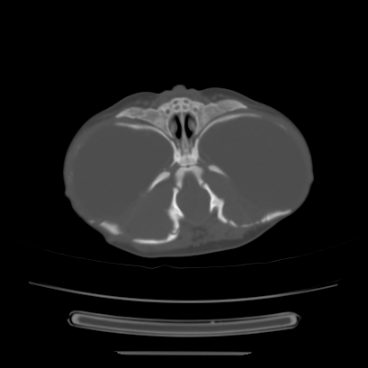 Cloverleaf skull (Radiopaedia 91901-109710 Axial bone window 52).jpg