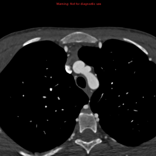 File:Coarctation of the aorta (Radiopaedia 12461-12697 A 31).jpg