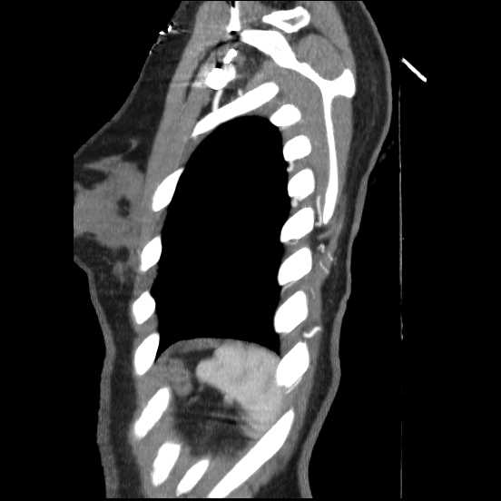 Coarctation of the aorta (Radiopaedia 67609-77010 C 8).jpg