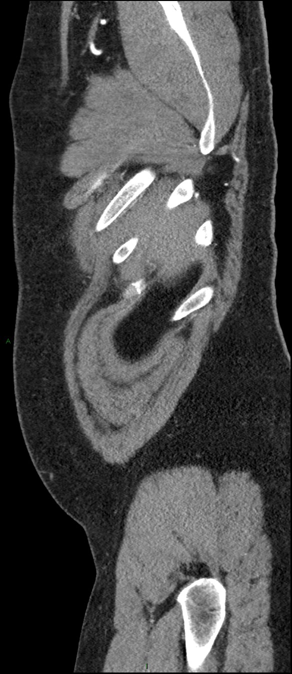 Coarctation of the aorta (Radiopaedia 74632-88521 C 15).jpg