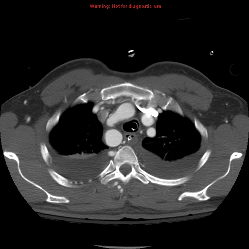 File:Coarctation of the aorta (Radiopaedia 8681-9490 B 17).jpg