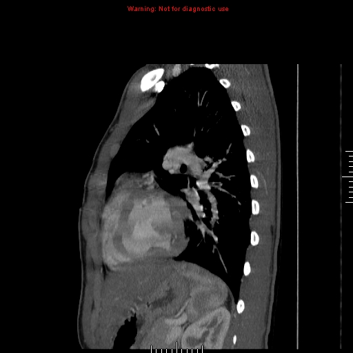 File:Coarctation of the aorta (Radiopaedia 9434-10118 B 42).jpg