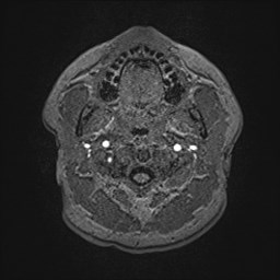 File:Cochlear incomplete partition type III associated with hypothalamic hamartoma (Radiopaedia 88756-105498 Axial T1 13).jpg