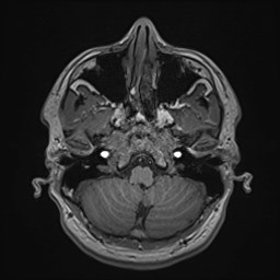 Cochlear incomplete partition type III associated with hypothalamic hamartoma (Radiopaedia 88756-105498 Axial T1 48).jpg