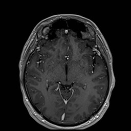 Cochlear incomplete partition type III associated with hypothalamic hamartoma (Radiopaedia 88756-105498 Axial T1 C+ 96).jpg