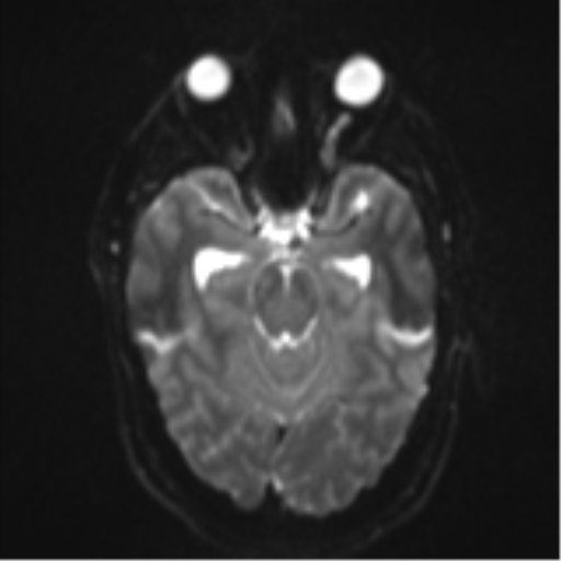 File:Colloid cyst (Radiopaedia 53164-59125 Axial DWI 10).png