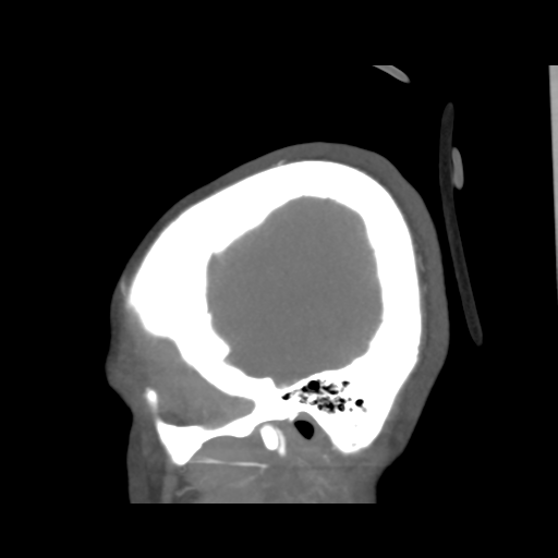 File:Colloid cyst (resulting in death) (Radiopaedia 33423-34499 B 52).png