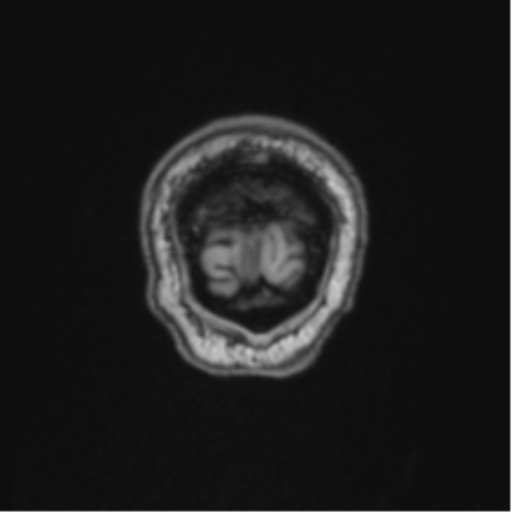 Colloid cyst of the third ventricle (Radiopaedia 86571-102662 Coronal T1 6).png