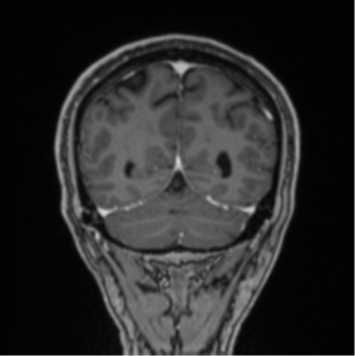 File:Colloid cyst of the third ventricle (Radiopaedia 86571-102662 Coronal T1 C+ 23).png
