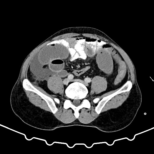 File:Colocolic intussusception due to large lipoma (Radiopaedia 68773-78482 A 129).jpg