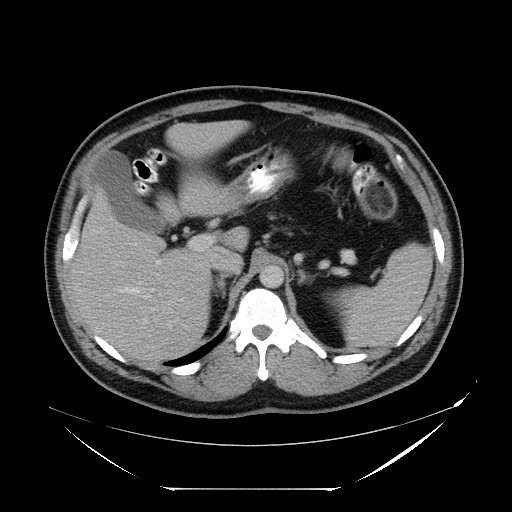 Colocolic intussusception due to lipoma (Radiopaedia 73712-84508 A 31).jpg