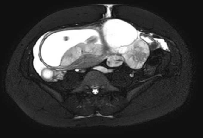 Colon adenocarcinoma with Krukenberg tumors, advanced pregnancy (Radiopaedia 67279-76645 Axial T2 SPAIR 31).jpg