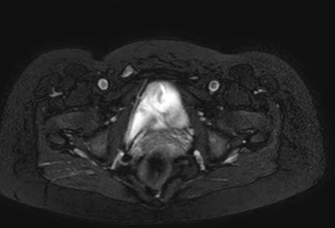Colon adenocarcinoma with Krukenberg tumors, advanced pregnancy (Radiopaedia 67279-76645 Axial T2 SPAIR 5).jpg