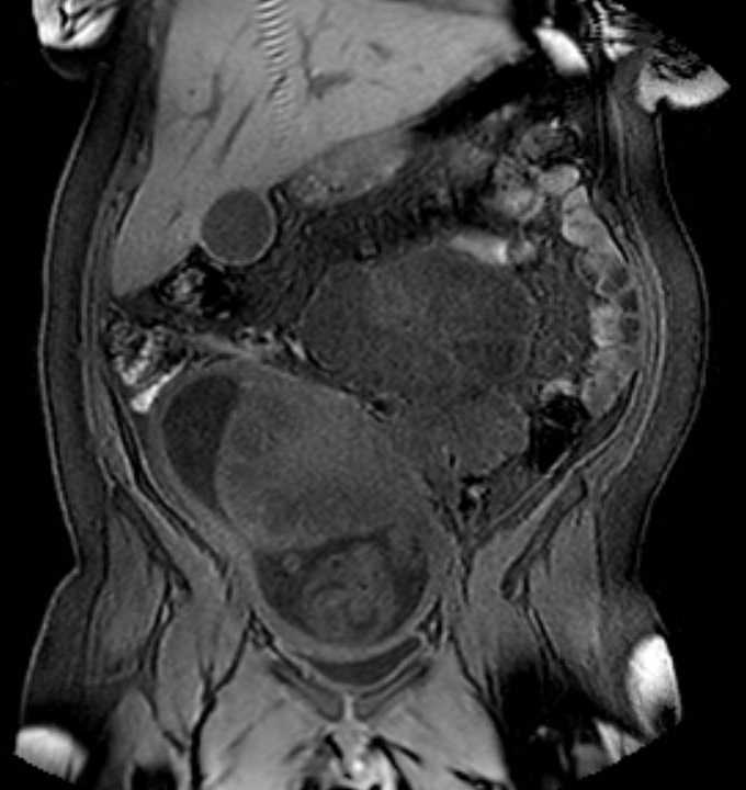 Colon adenocarcinoma with Krukenberg tumors, advanced pregnancy (Radiopaedia 67279-76645 E 34).jpg
