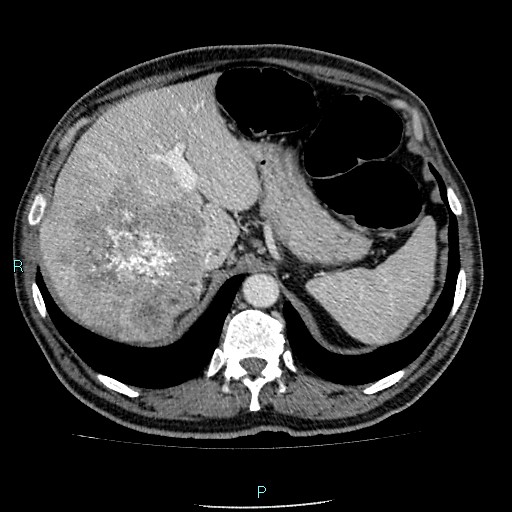Colon adenocarcinoma with calcific liver metastasis (Radiopaedia 55745-62300 B 8).jpg