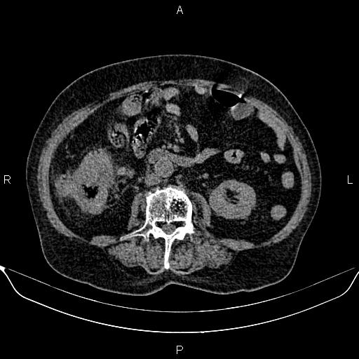 File:Colon cancer (Radiopaedia 90215-107432 Axial non-contrast 49).jpg