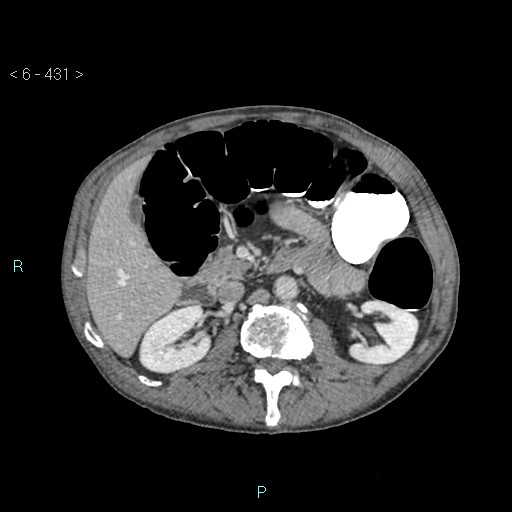 File:Colonic cancer (ultrasound and TC imaging) (Radiopaedia 50346-55713 A 38).jpg