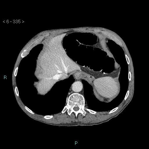 File:Colonic cancer (ultrasound and TC imaging) (Radiopaedia 50346-55713 B 335).jpg