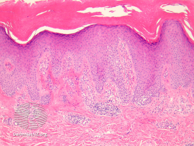 File:Figure 1 (DermNet NZ pathology-e-ilven-fig1).jpg