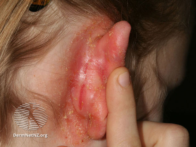 File:Infected eczema (DermNet NZ dermatitis-s-atopic17).jpg