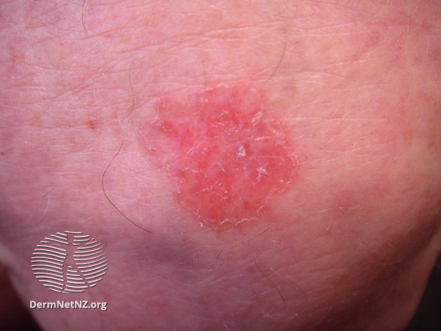 File:Intraepidermal carcinoma (DermNet NZ lesions-scc-in-situ-2945).jpg