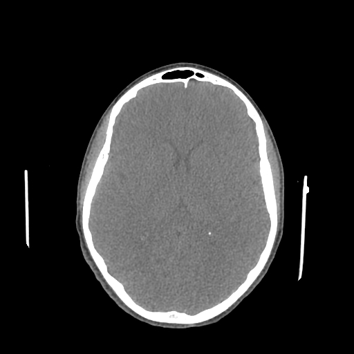Nasal pyogenic granuloma (lobular capillary hemangioma) (Radiopaedia 85536-101244 Axial non-contrast 132).jpg
