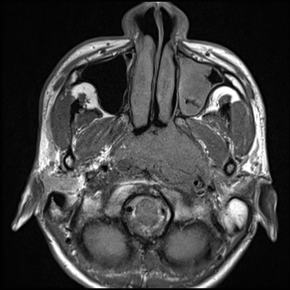 Nasopharyngeal carcinoma with skull base invasion (Radiopaedia 53415-59485 Axial T1 29).jpg