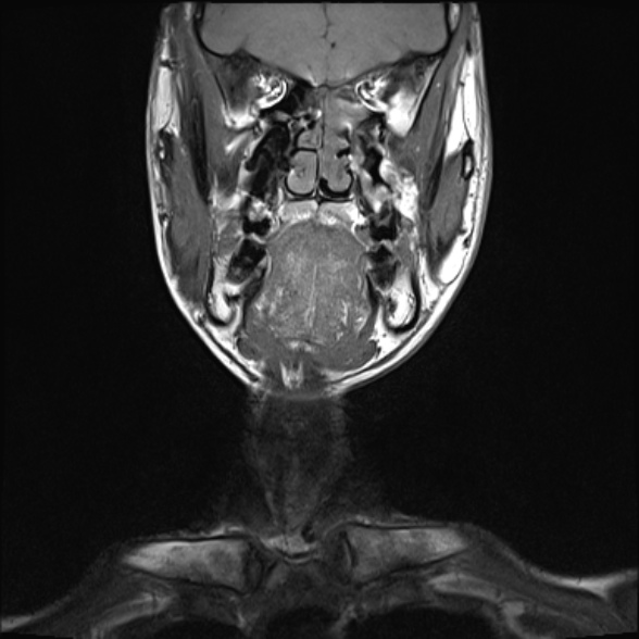 Nasopharyngeal carcinoma with skull base invasion (Radiopaedia 53415-59485 Coronal T1 29).jpg