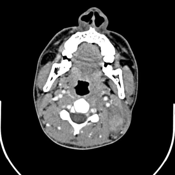Nasopharyngeal carcinoma with skull base invasion (Radiopaedia 53415-59705 A 94).jpg