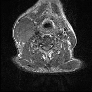 File:Nasopharyngeal carcinoma with skull base invasion (Radiopaedia 59258-66600 Axial T1 6).jpg