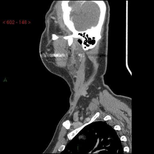 File:Nasopharyngeal lymphoma (Radiopaedia 54235-60433 B 48).jpg