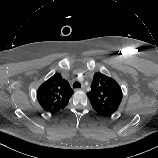 Neck CT angiogram (intraosseous vascular access) (Radiopaedia 55481-61945 B 70).jpg