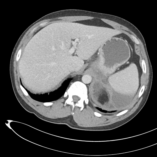 File:Necrotizing pancreatitis with acute necrotic collections (Radiopaedia 38829-41012 B 18).png