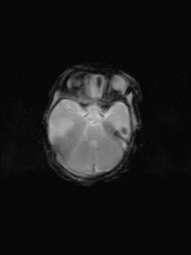 File:Neonatal hypoxic-ischemic encephalopathy (Radiopaedia 41406-44277 Axial Gradient Echo 14).jpg