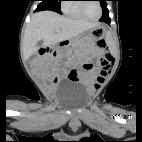 File:Neonatal neuroblastoma (Radiopaedia 56651-63438 Coronal non-contrast 20).jpg