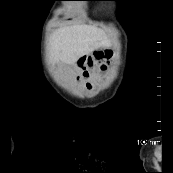 File:Neonatal neuroblastoma (Radiopaedia 56651-63438 Coronal non-contrast 7).jpg