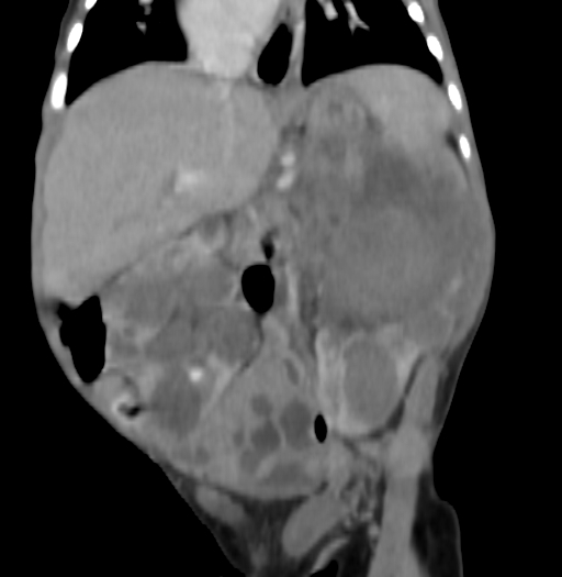 Nephroblastomatosis (Radiopaedia 71294-81607 B 189).jpg