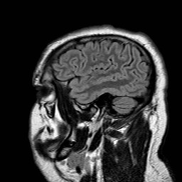 File:Neuro-Behcet's disease (Radiopaedia 21557-21506 Sagittal FLAIR 30).jpg