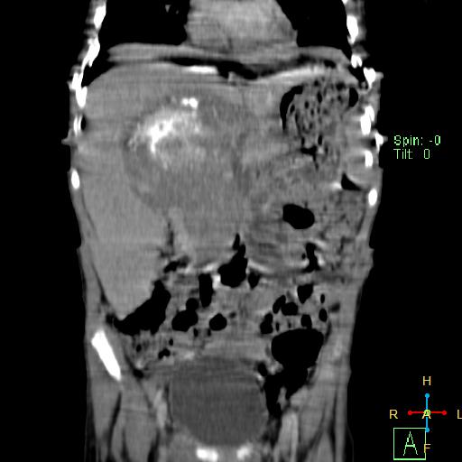 File:Neuroblastoma (Radiopaedia 24751-25016 B 11).jpg