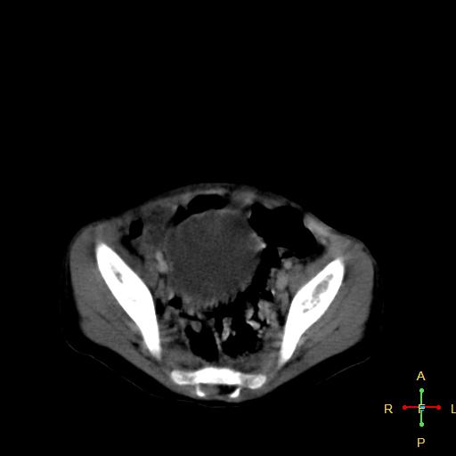 File:Neuroblastoma (Radiopaedia 24751-25016 D 36).jpg