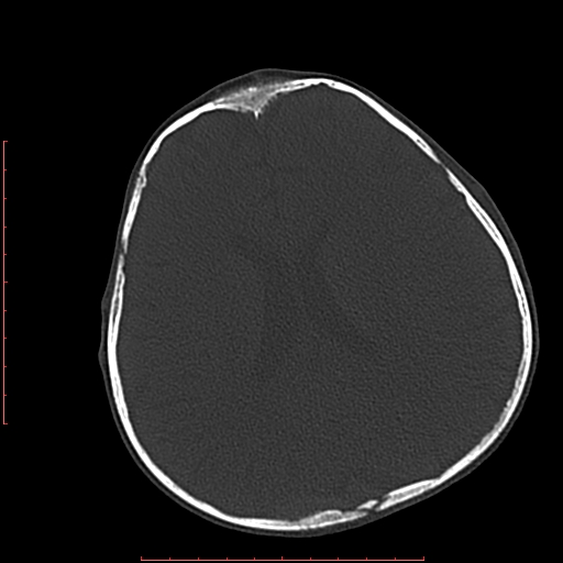 File:Neuroblastoma skull metastasis (Radiopaedia 56053-62683 Axial bone window 16).jpg