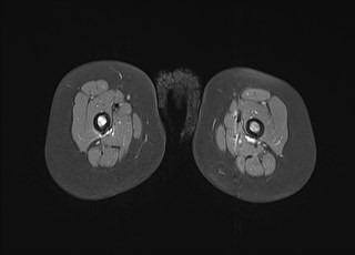 File:Neuroblastoma with bone metastases (Radiopaedia 67080-76414 Axial T1 C+ fat sat 31).jpg